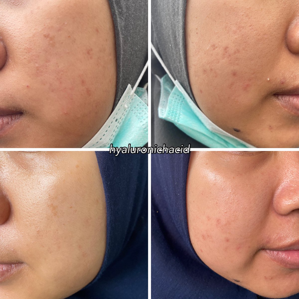 hyaluronichacid's tweet photo. Hah kok bisa sih datang bulan tapi ga ada muncul jerawat?!? Malahan kulit jadi mulus gini lohhh

Ternyata karena aku lagi rajin pake 2 produk ini di skincare routine aku🥹

🛒 https://t.co/roQrWxponr

#biobeautylab #racuninskincare #reviewskincare https://t.co/bRq8U4A2k5