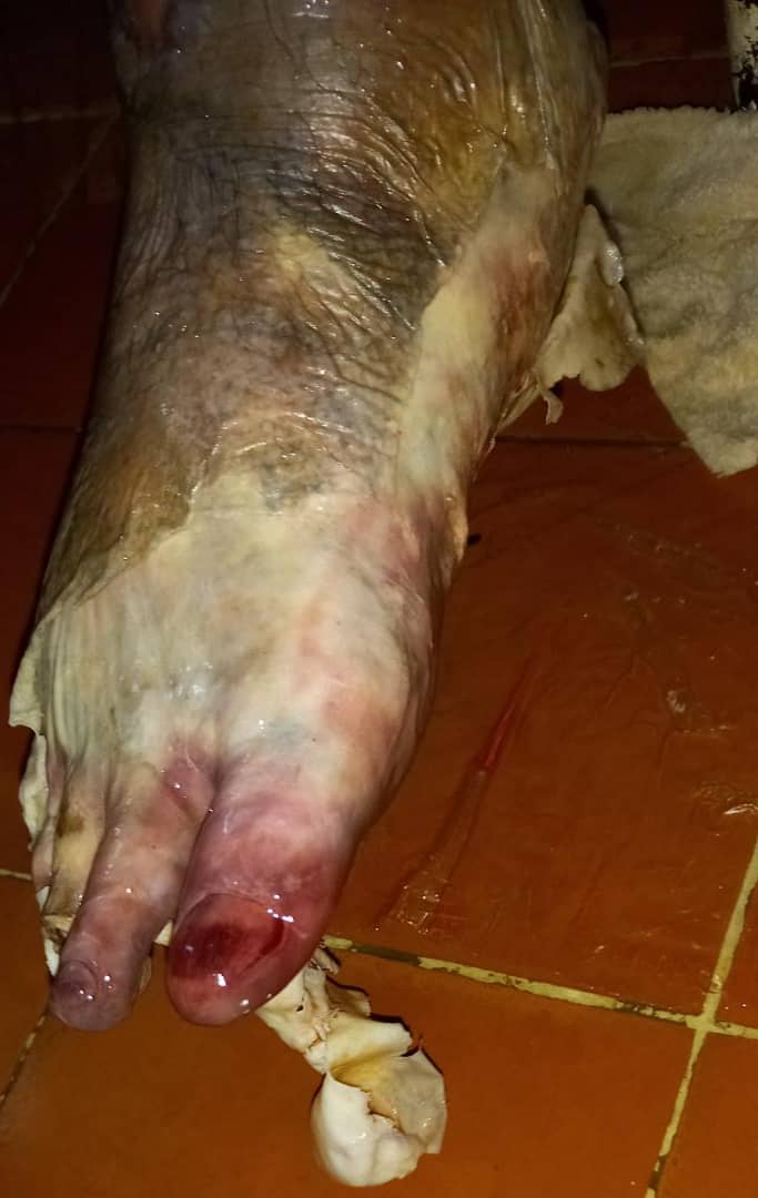 #ServicioPúblico  
Ayudemos a orlando!
Tiene 73 años presenta artereopatia periférica obstructiva por Ateromatosis.
Requiere amputación por tal motivo sus familiares necesitan el apoyo para cubrir con los gastos de la cirugía. 

Pago móvil:
0108 19423215 04267837584
(Provincial)