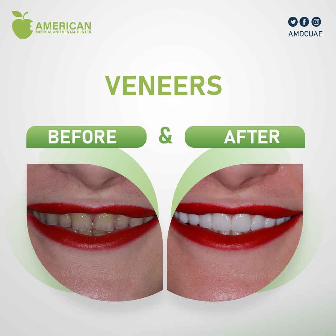 AMDCUAE's tweet photo. Sit back and relax as we transform your smile. At AMDC, we offer the best in cosmetic dentistry with veneers for clients such as yourself. 🦷

#DentalRootTreatment #DentalRestorations #DentalImolants #DentalClinics #ToothImolant #UAEDental #UAEdentis https://t.co/ljFNmYZeNe