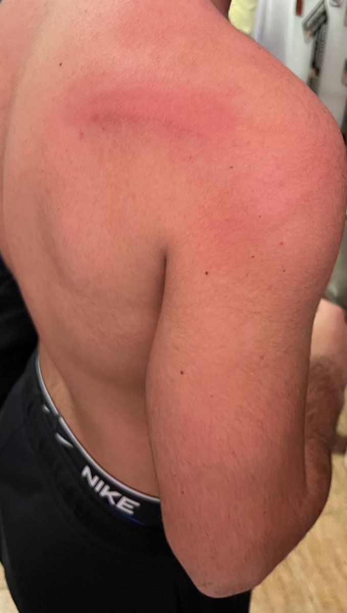 gradauda's tweet photo. Estas son las consecuencias de acudir a un recibimiento en Almería. Juzguen ustedes. https://t.co/6MHznw77oC
