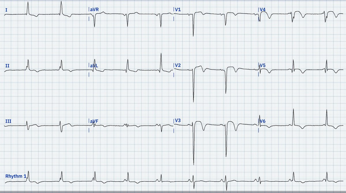 LopezLizarraga_'s tweet photo. Hombre 65 años.
Diagnóstico reciente de #Iamcest anterior.
Cuál es el ritmo?
#EPeeps #FOAMed @DidlakeDW @JL_MoralesArt @Arritmias_HRC @UlhasDr @AlejandroAG_MD @PMcardioBot @falsapelirroja @Hapa_EP @the_cardiomedic @HiguerasJavier @LuisUrqieta @ValdoCasMtz @DrMontanezA https://t.co/4x6TwUr1DP