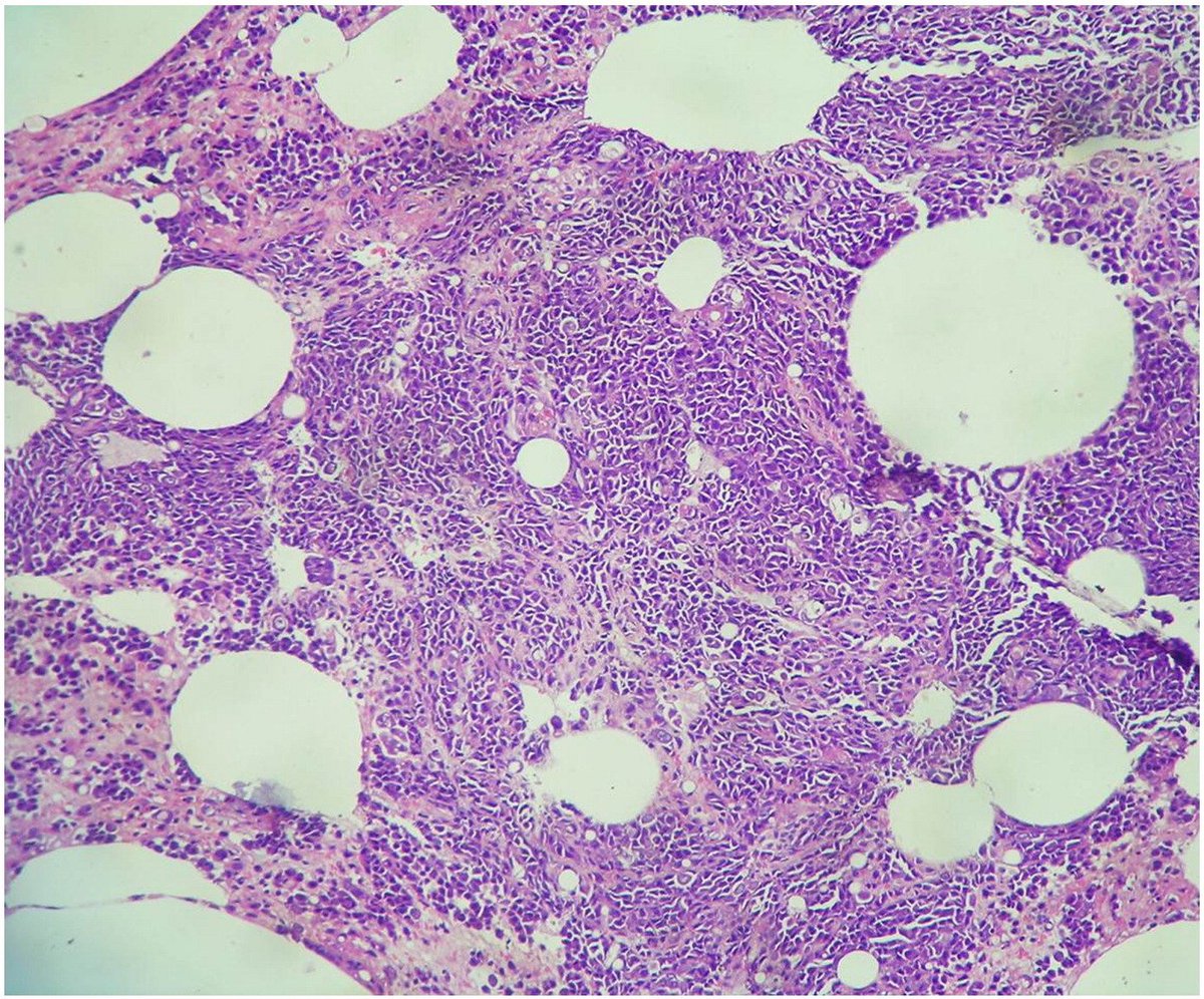 The CAT (Calcified Amorphous Tumor) 🐱 and MICE (Mesothelial/Monocytic Cardiac Excrescences) 🐀 in the Heart.❤🔬
#CVPath

Photo credits: 
Ruchika Gupta (CAT)
Gayathri Amonkar (MICE).

#February2023