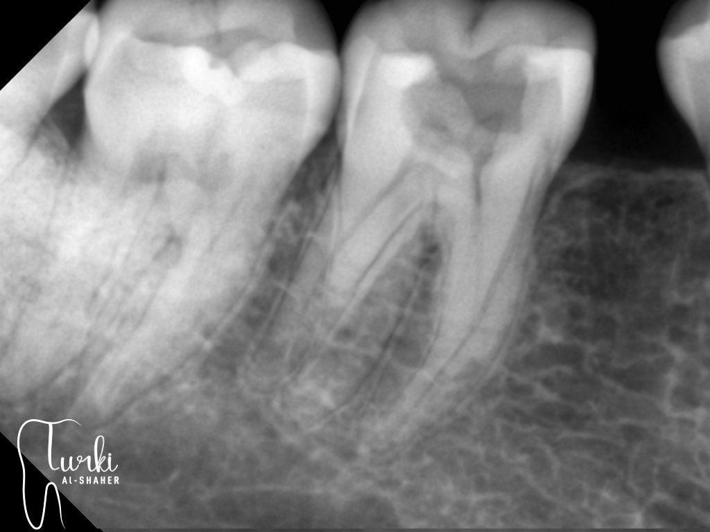 Turkidontia's tweet photo. RCT for lower right first molar with Radix .
#endodontics https://t.co/0MSaqGB097