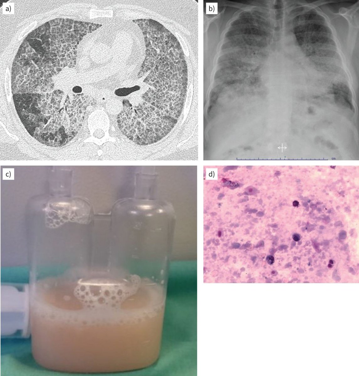 ERR: Many rare and ultrarare ILDs are underdiagnosed. Increasing insight into pathobiology, genetics and disease behaviour have led to better treatment options. Early consultation with or referral to expert centres (<a href="/ErnLung/">ERN-LUNG</a>) is advised. bit.ly/3vwYrib