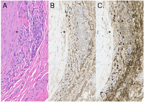 MdWarrington's tweet photo. Now published by @KaymakciMd 

IgG4-Related Disease: A Giant Cell Arteritis Mimic https://t.co/GqaenPf0ZP 

Temporal #arteritis with IgG4 stain (C) #vasculitis https://t.co/w7Jrd9Ib9t