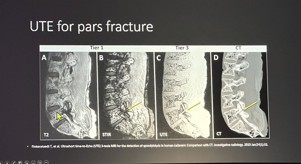 The_ASSR's tweet image. Our #ASSR23 Vice President @LeviChazen from @HSpecialSurgery teaches us about Bone MRI in the Spine Imaging Innovations &amp;amp; AI session. Fascinating how we can turn an MRI into CT bone images! -@JudyGadde #NeuroRad #SpineRad