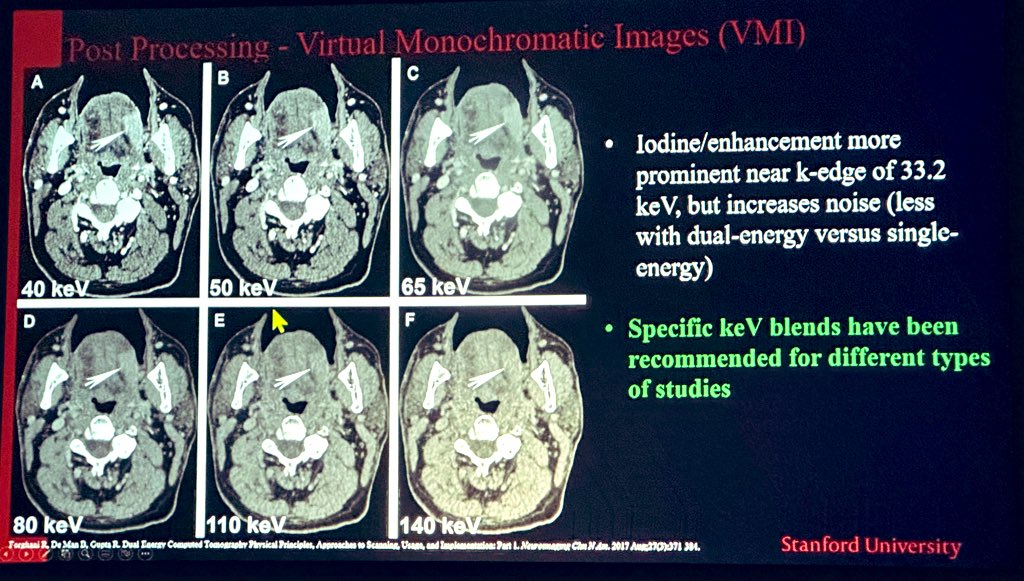 The_ASSR's tweet image. Next up is @KSeifertMD from @stanfordneuroi1 @StanfordRad teaching us about Dual Energy CT at #ASSR23! Thank you for this fantastic review! -@JudyGadde #NeuroRad #SpineRad