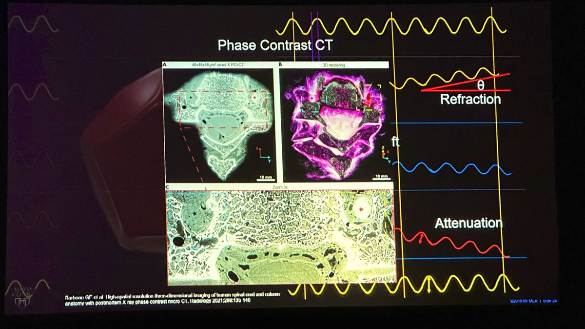 To end this fantastic #ASSR23 session on innovation, Dr. Vance Lehman from <a href="/MayoRadiology/">Mayo Clinic Radiology</a>, teaches us about Future Imaging, including photon counting CT, phase contrast CT, and #AI! -<a href="/JudyGadde/">Judy Gadde, DO, MBA</a> #NeuroRad #SpineRad