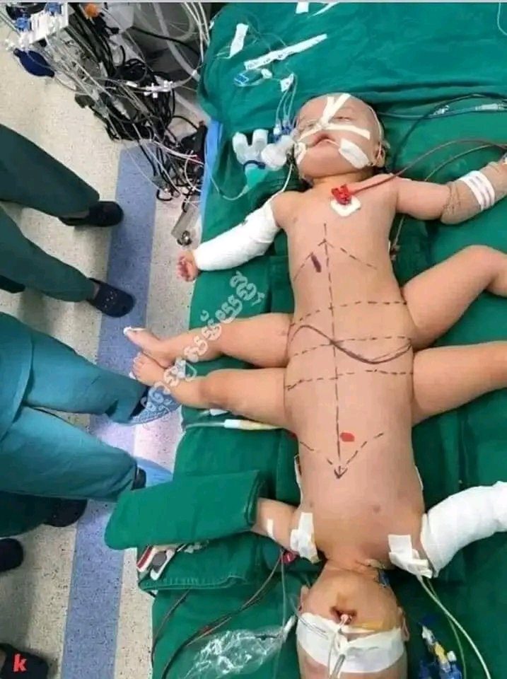 EllenDomaeko's tweet photo. The twins are classified as a pair of very rare conjoined twins. A pair of conjoined twins was successfully separated in Ho Chi Minh City on July 15, in an operation which involved more than 90 doctors, nurses and medical experts and lasted for 13 hours and 40minutes, 
July 2020 https://t.co/lxSACjQRUx