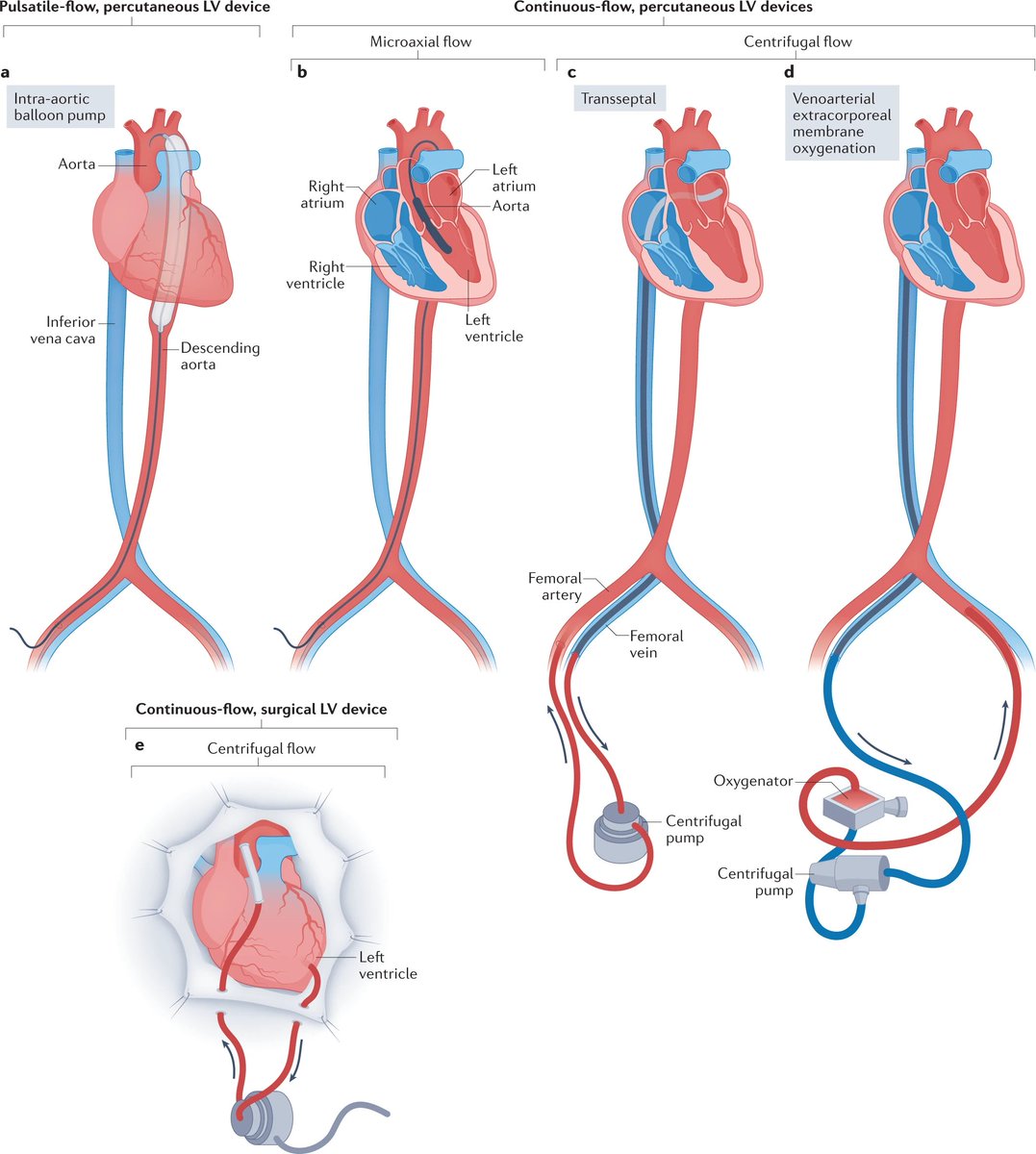 Left and right ventricular circulatory support devices. 🔗nature.com/articles/s4156… #MedEd #FOAMcc #CriticalCare #FOAMed 1⃣ Left 👇 Click 'ALT' for figure description