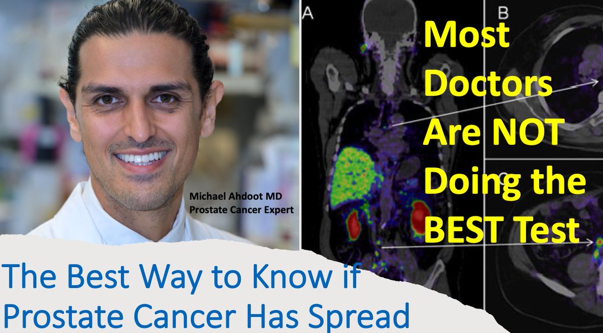 There is a new kind of the hill when it comes to detecting prostate cancer metastasis. For those who want a brief review of the literature on PSMA PET Scans vs Bone Scan + CT. 
*Spoiler alert, PSMA scans are way better but not perfect! @Cancerbetter
youtube.com/watch?v=9rwUF_…