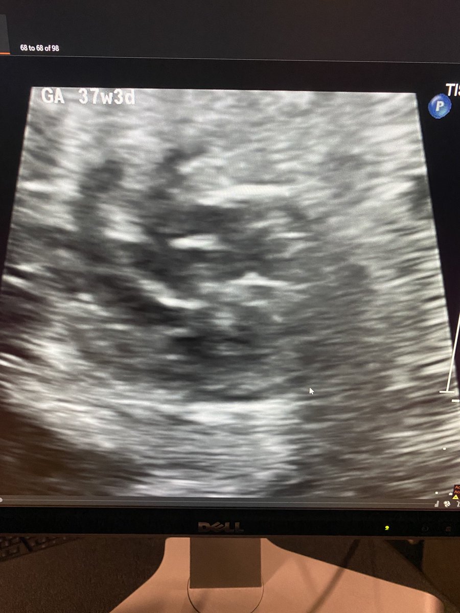 Name the diagnosis from this fetal echo #MedTwitter