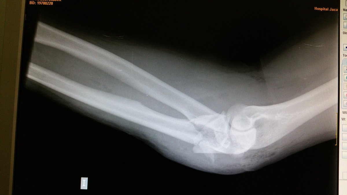 EvolvedClinic's tweet photo. @pttimyyc My personal experience is that post-traumatic elbows always lose ROM in extension https://t.co/RN1iNaUC3h