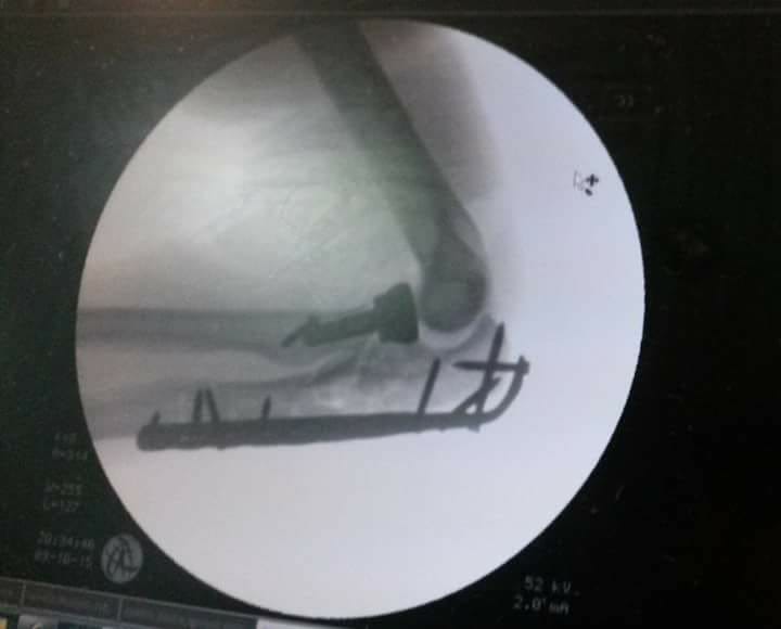 EvolvedClinic's tweet photo. @pttimyyc And after the second surgery https://t.co/3CW4XTzPyd