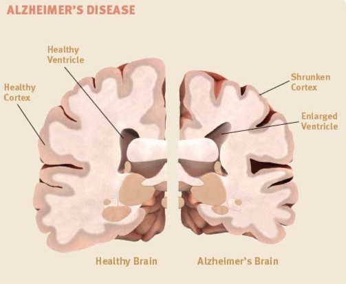 BrainHealth_AAN's tweet photo. Not all #dementia is #Alzheimers disease. Learn the four most common types of dementia—as well as four not-so-common ones: https://t.co/EU7Gp0UNux

#MemoryLoss #Depression #BrainAndLife https://t.co/xpq8tH5UAN