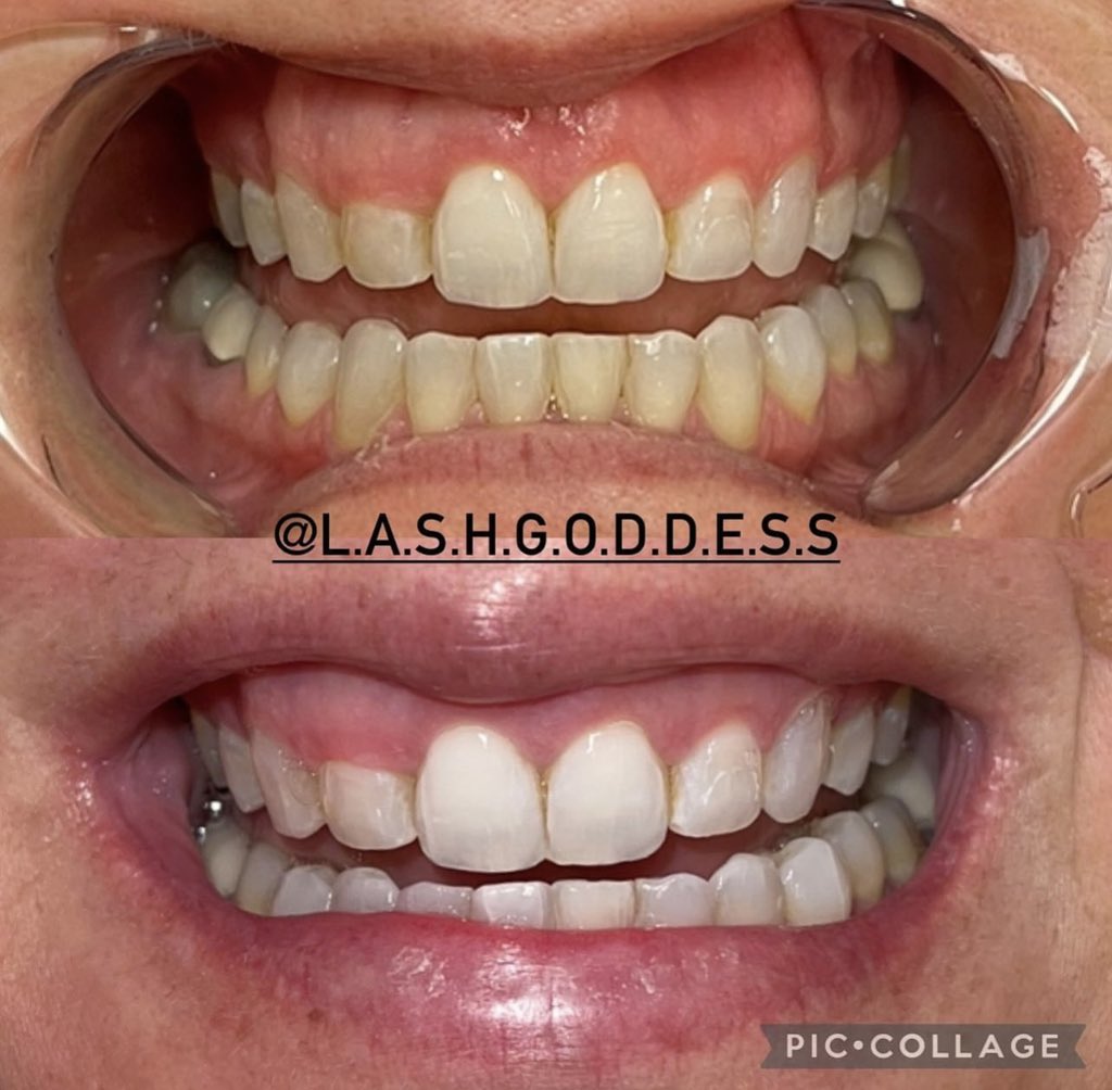 lashgoddesswv's tweet photo. 1 session of teeth whitening 🤍 

 #charlestonwv  #charlestonwvlashes #wvlashes  #teethwhitening #teethwhiteningspecialist #whiteteeth #ledteethwhitening #lashgoddesswv #beforeandafter #beforeandafterteeth #smilemakeover #teethbeforeandafter #smilebeforeandafter https://t.co/QUt4m3O3pe
