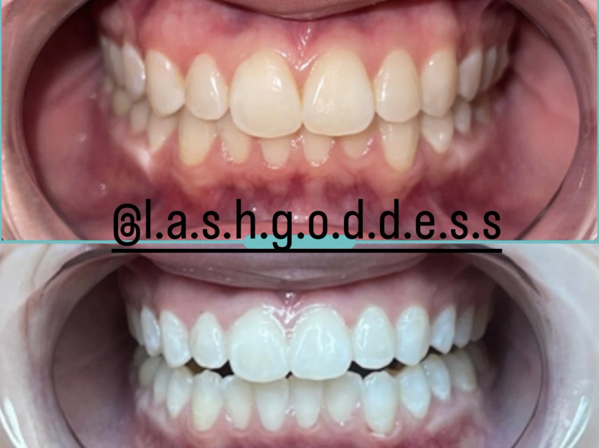 lashgoddesswv's tweet photo. pearly whites🤍

#charleston #charlestonwv #charlestonwvhair #lashgoddesswv #teethwhitening #teethwhiteningspecialist #whiteteeth #ledteethwhitening #wvdental #beforeandafter #beforeandafterteeth #smilemakeover #teethbeforeandafter #smilebeforeandafter #pearlywhites https://t.co/GAWxh1Qdeg