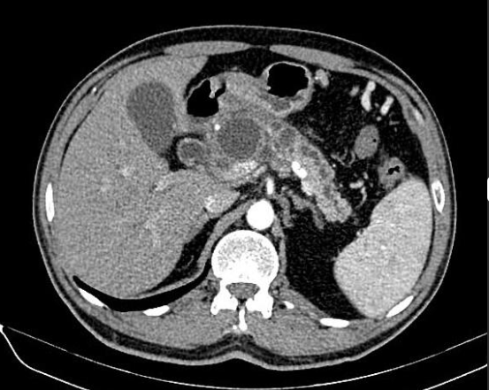 drmtniknejad's tweet photo. Case of the day #Radiopaedia
Chronic pancreatitis with #pseudocysts mimics intraductal papillary mucinous neoplasms (IPMN). Imaging differentiation may be tricky and often requires endoscopic FNA for definitive diagnosis.

See the full case: https://t.co/GK9uKPzzoi https://t.co/MYS77uAiRn