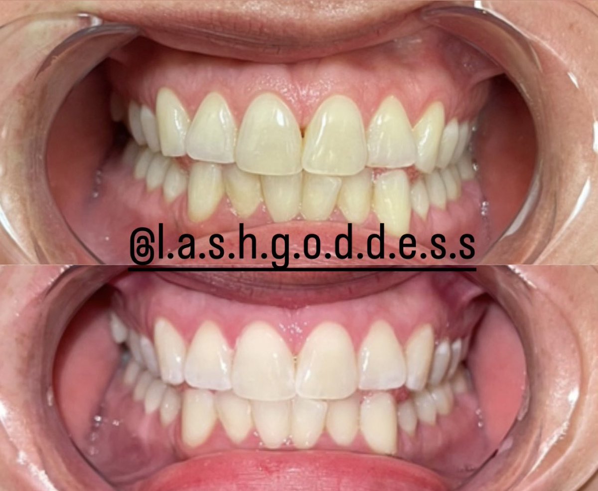 lashgoddesswv's tweet photo. 🤍🤍🤍

#charleston #charlestonwv #lashgoddesswv #teethwhitening #teethwhiteningspecialist #whiteteeth #ledteethwhitening #wvdental #beforeandafter #beforeandafterteeth #smilemakeover #teethbeforeandafter #smilebeforeandafter #beforeandaftersmile #pearlywhites https://t.co/3zeYEhGmu5