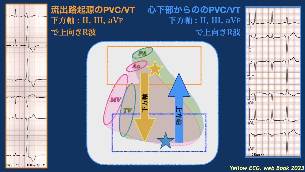 NaokiThukishima's tweet photo. #YellowPVC-09

流出路PVCでは、下方軸(↓)なので、下壁誘導で高いR波が認められます。

下壁側からのPVCでは、上方軸(↑)なので、下壁誘導でrS(QS)パターンが認められます。 https://t.co/iKhkXdhWL6