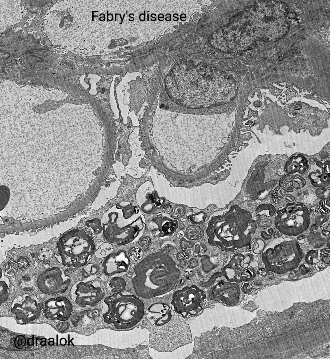draalok's tweet image. All in a days work! Diverse conditions featuring lamellated lysosomal inclusions. Kidney (Fabry&apos;s disease &amp;amp; HCQS toxicity in SLE/ lupus nephritis), Nerve (Amiodarone toxicity) and lung surfactant (normal) in alveoli! #nephtwitter #PathTwitter #electronmicroscopy #zebrabody