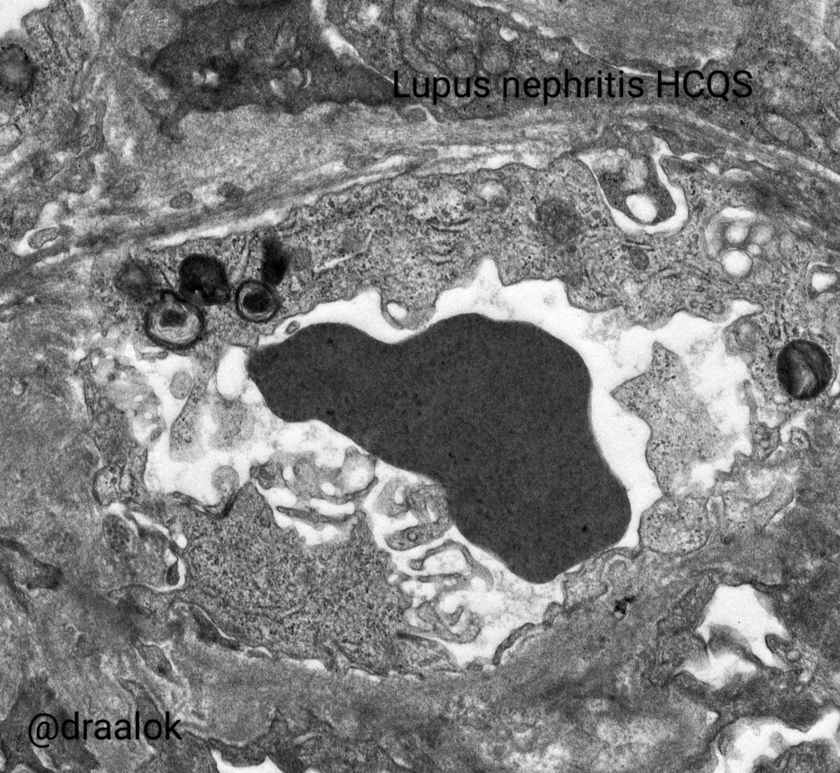 draalok's tweet image. All in a days work! Diverse conditions featuring lamellated lysosomal inclusions. Kidney (Fabry&apos;s disease &amp;amp; HCQS toxicity in SLE/ lupus nephritis), Nerve (Amiodarone toxicity) and lung surfactant (normal) in alveoli! #nephtwitter #PathTwitter #electronmicroscopy #zebrabody