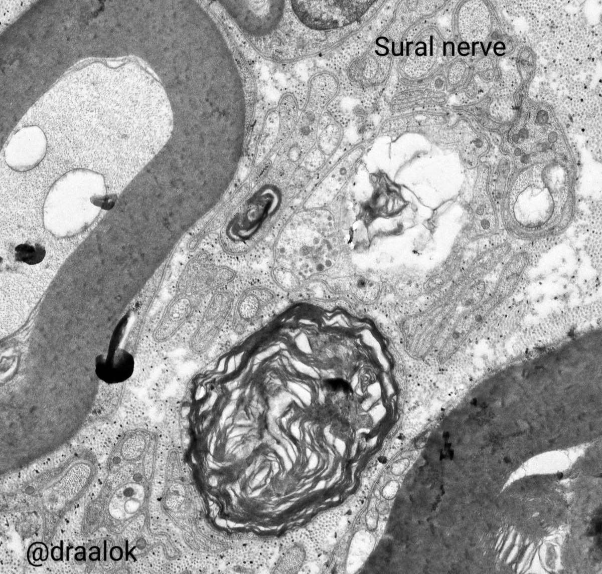 draalok's tweet image. All in a days work! Diverse conditions featuring lamellated lysosomal inclusions. Kidney (Fabry&apos;s disease &amp;amp; HCQS toxicity in SLE/ lupus nephritis), Nerve (Amiodarone toxicity) and lung surfactant (normal) in alveoli! #nephtwitter #PathTwitter #electronmicroscopy #zebrabody