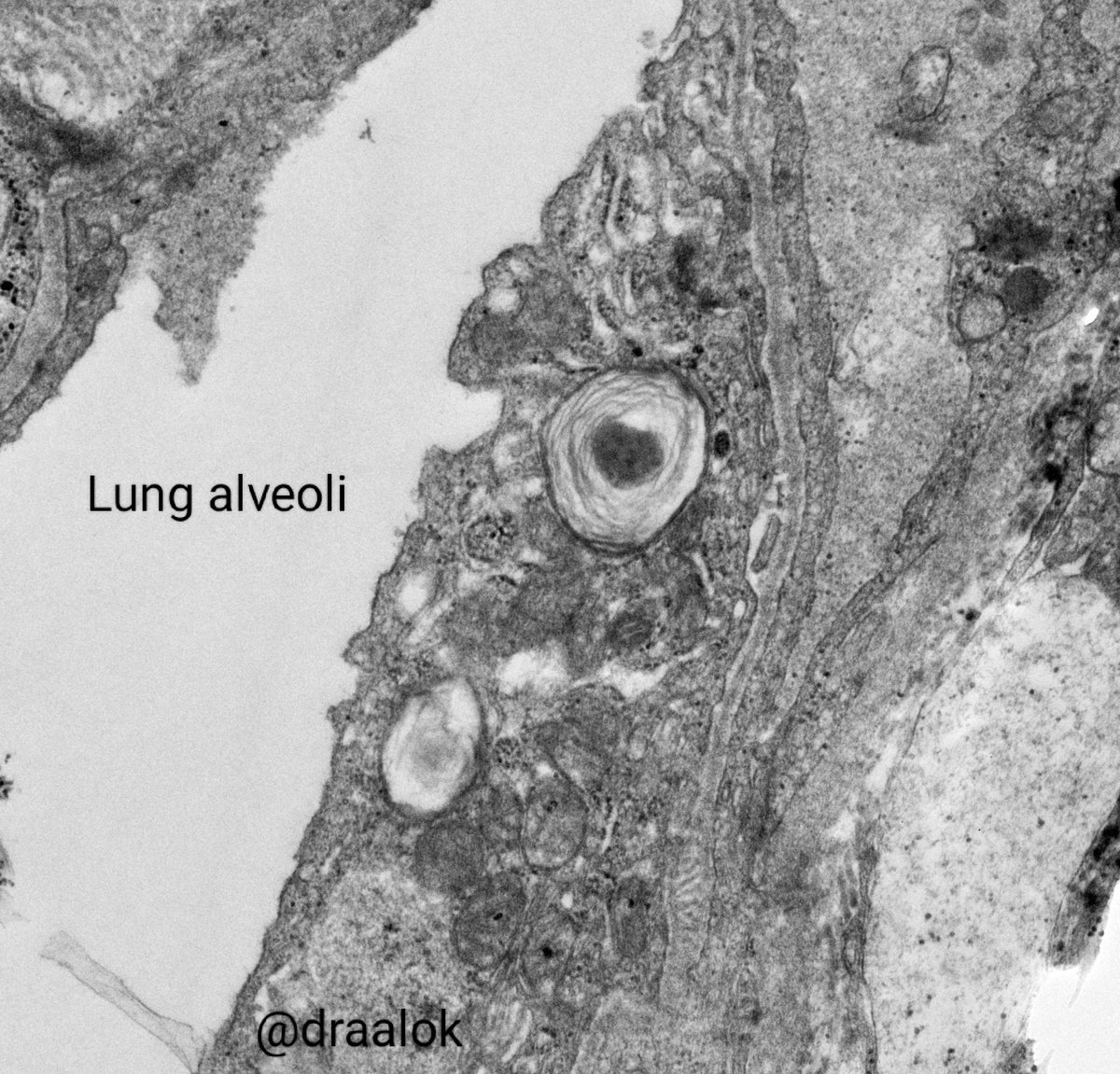draalok's tweet image. All in a days work! Diverse conditions featuring lamellated lysosomal inclusions. Kidney (Fabry&apos;s disease &amp;amp; HCQS toxicity in SLE/ lupus nephritis), Nerve (Amiodarone toxicity) and lung surfactant (normal) in alveoli! #nephtwitter #PathTwitter #electronmicroscopy #zebrabody