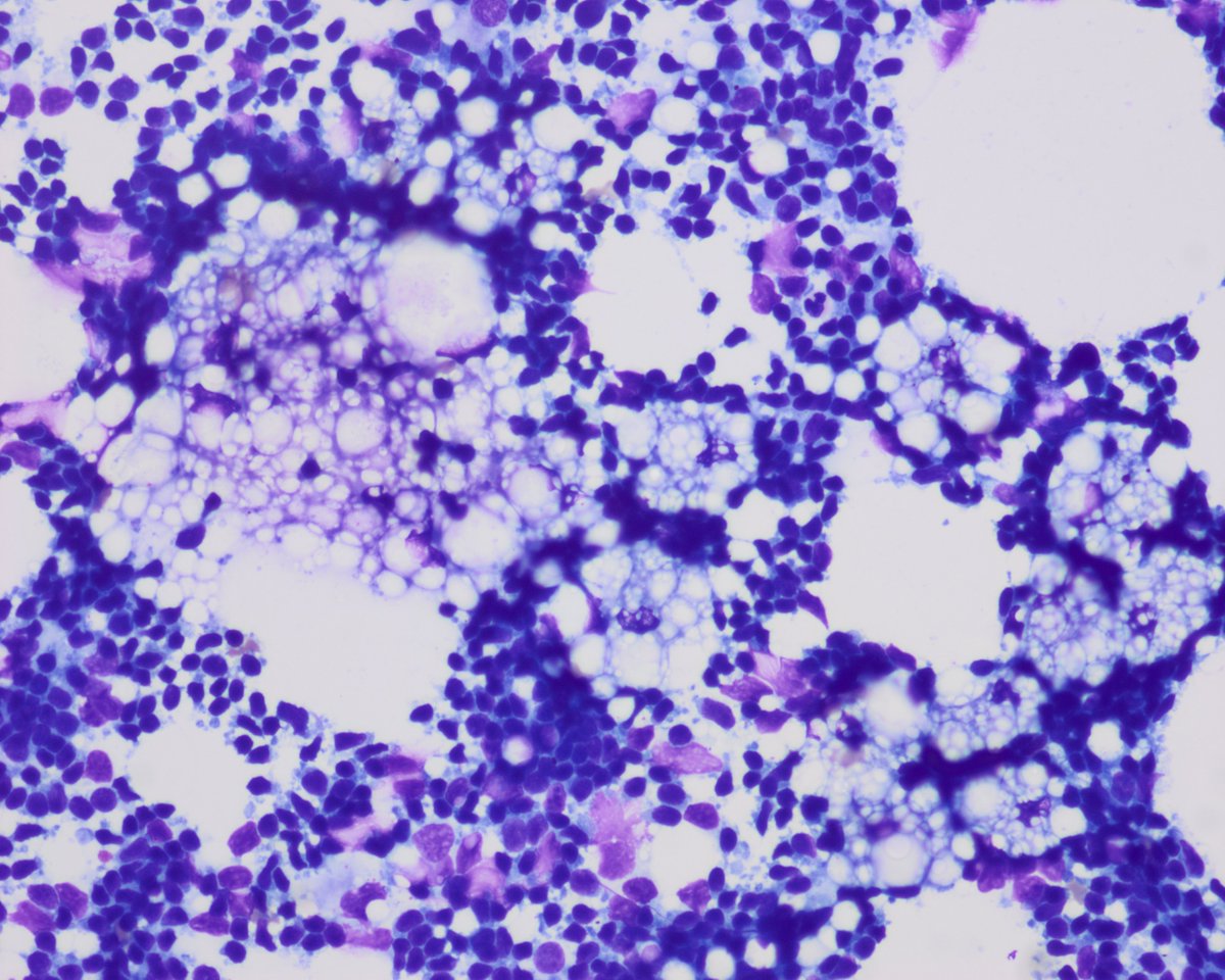 CC256. ♀️40s. Large bilateral inguinal nodes. 'Rule out lymphoproliferative disorder'. I sent for flow cytometry. They had to buy a new one. #cytology