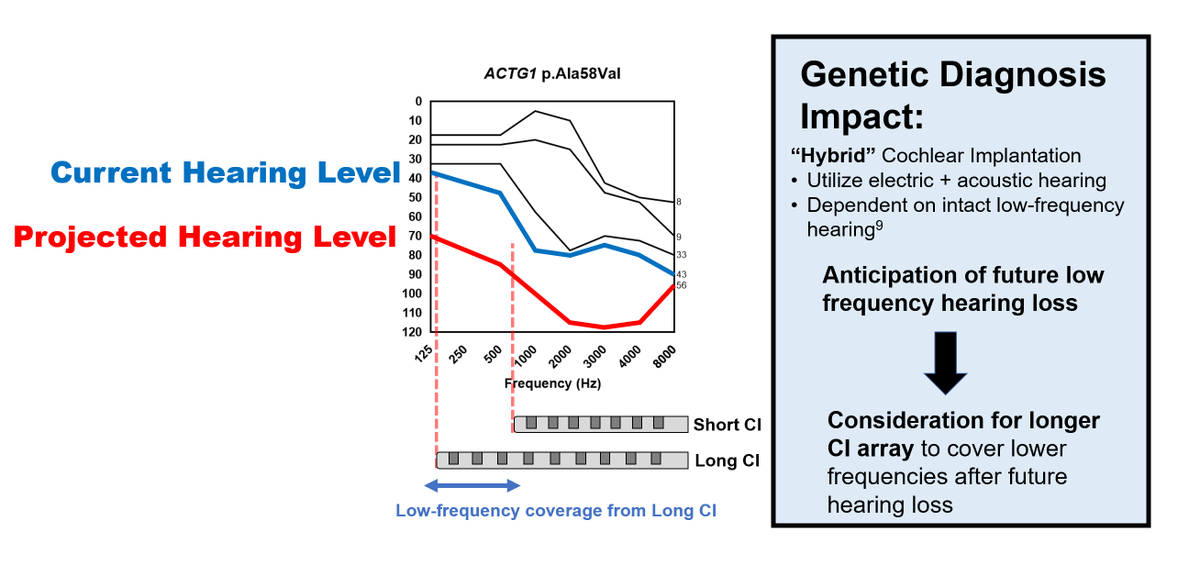 Dr. Alexander Claussen discusses how genetic testing contributes unique information to pre-operative cochlear implant evaluation &amp; influences clinical &amp; surgical decision making in cochlear implant patients @ SU99 #ARO2023 
<a href="/AROMWM/">ARO</a>
 <a href="/IowaOto/">Iowa Oto</a> 
<a href="/IowaMed/">Carver College of Medicine</a>
