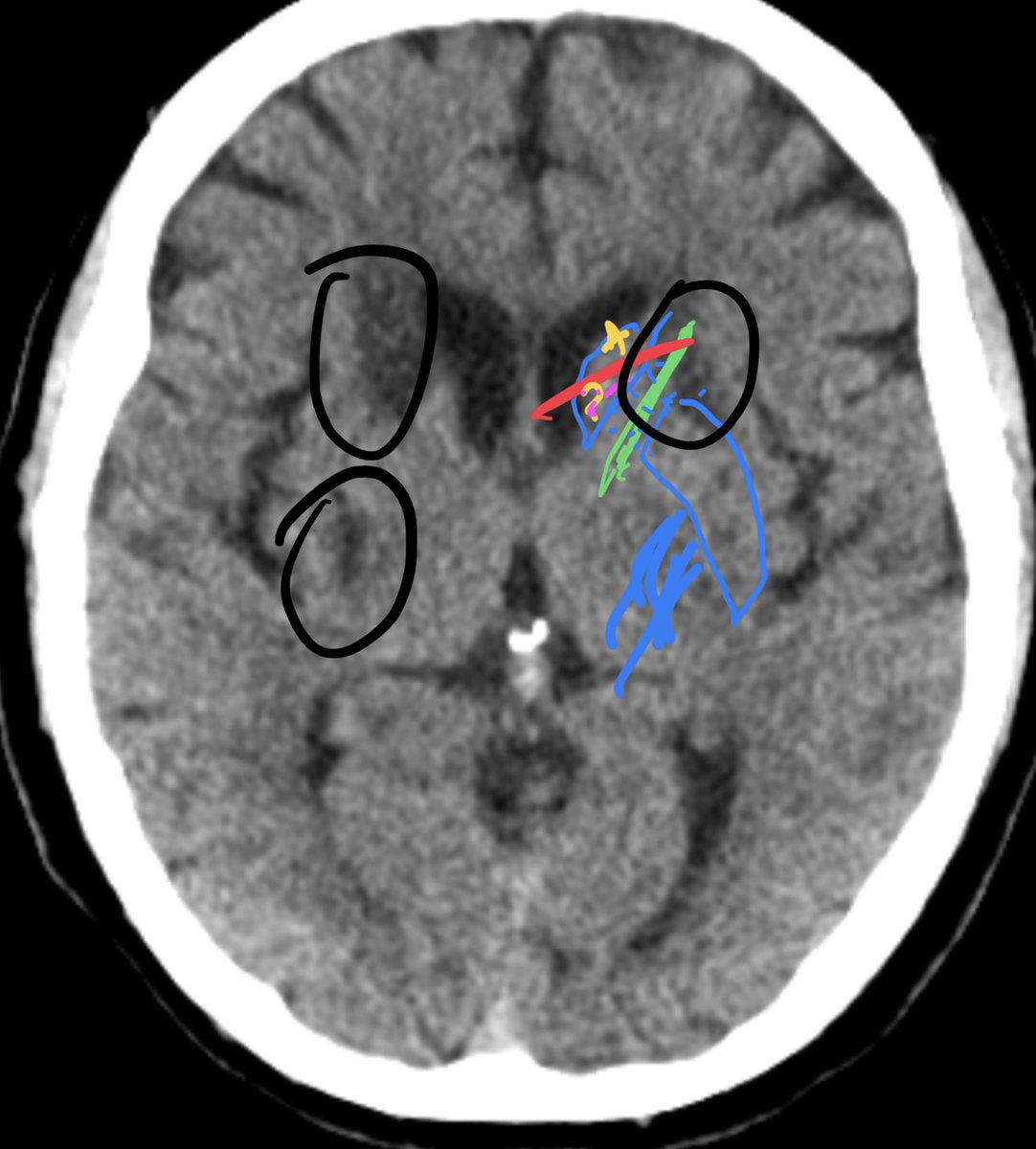 ACV Silencioso
- 👨🏻👩 HTA, DM2, Obesidad pueden haber sufrido ACV y no saberlo 

- ACV Silenciosos son daños en el tejido 🧠 que cursan oligosintomaticos 

Quejas “todo se me olvida” “me estoy poniendo lento” pueden ser señal

Img👇🏻
Circulos ACV Silencioso en pte HTA asintomático