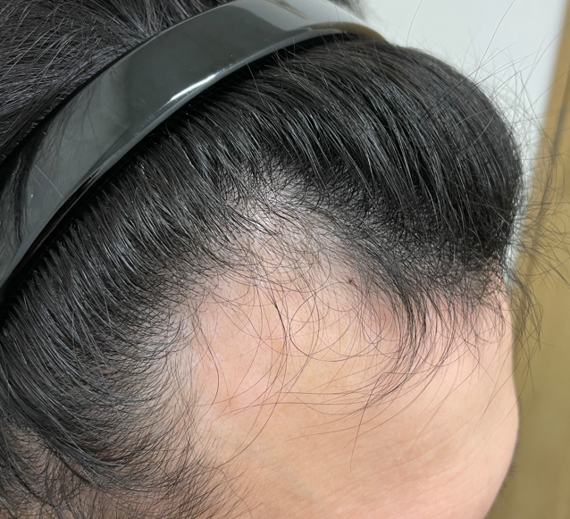 30s_aga's tweet photo. 現在29歳の私ですが56万円のローンを組んで1年間のAGA治療をはじめることにしました。もともと遺伝的にも30歳になったらはじめようと思っていましたが、手遅れになるその前にと思い、勇気を出してはじめました。毎月の経過を写真に撮って効果を実感したいと思います。同じ悩みの人にも届きますように！ https://t.co/mkW9IoqdvJ