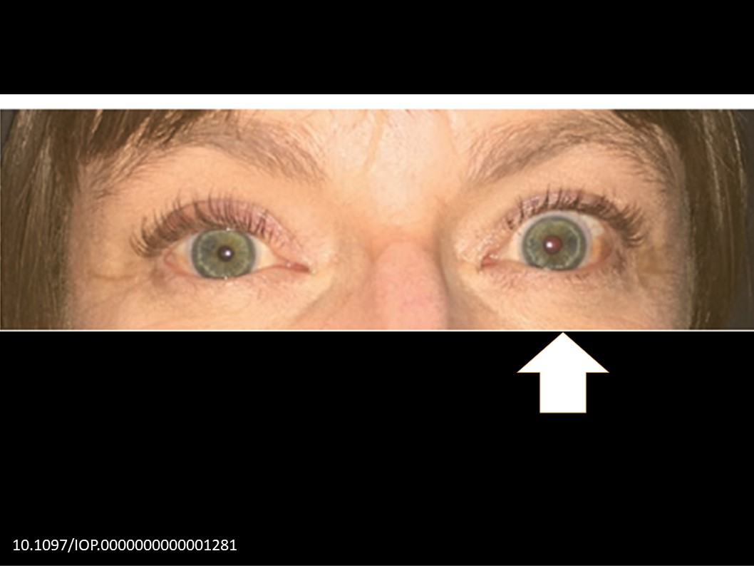 XRPL__A's tweet photo. Pourfour du Petit (PDP) syndrome. [Aka -Reverse Horner’s syndrome] Characterised by Unilateral mydriasis, Eyelid retraction &amp; Ipsilateral Facial Hemihyperhidrosis https://t.co/iPO6jW2Yh1