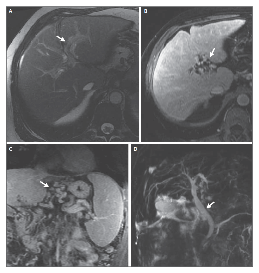 NEJM's tweet photo. Case Records of the Massachusetts General Hospital: A 56-Year-Old Man with Abnormal Results on Liver Testing

https://t.co/IuYes4Dwpu https://t.co/2G9i4DllB9
