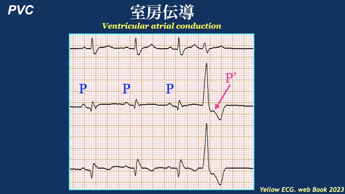NaokiThukishima's tweet photo. #YellowPVC-13

心房から心室へ伝導するのが、房室伝導(AV conduction)
心室から心房へ伝導するのが、室房伝導(VA conduction)

ぼ〜としていると読み違えるんで、PVC学ぶ時は注意しましょうね。 https://t.co/B94O9mnAi6