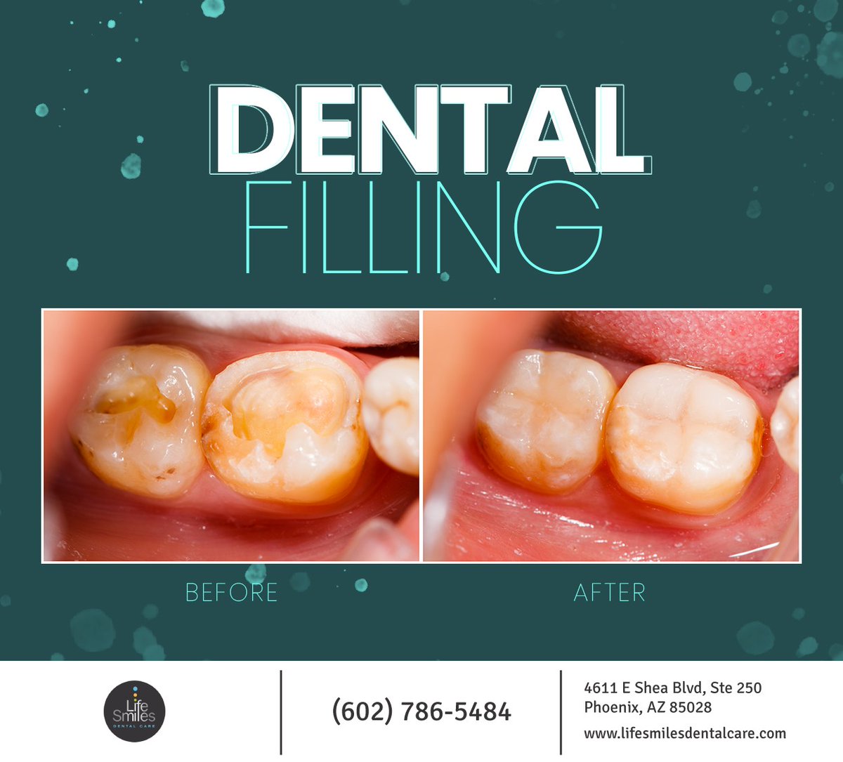 Tooth decay can lead to infection and eventually to tooth loss if ignored. A tooth filling will help repair decay, prevent infection and inflammation, and preserve your smile. Call New Patients: (602) 786-5484 / Existing Patients: (602) 404-7266 for an appointment.