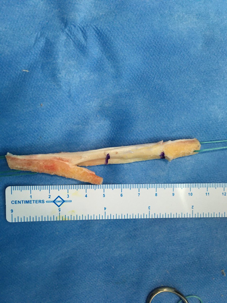 ligamentsurgeon's tweet photo. @bethshubinstein Harvest a BTB with a tibial bone plug extension this is our answer for graft tunnel mismatch.look at the marked length of the graft will be around 25-30mm. We’ve been using this technique for over 15years never had a mismatch 😊 https://t.co/PVNRK75H8W