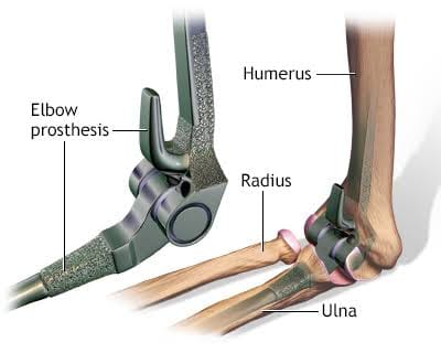 Vivekmadhvimuku's tweet photo. #ElbowReplacement involves surgically replacing bones that make up the elbow joint with artificial elbow joint parts ,, https://t.co/gZki5p11HN