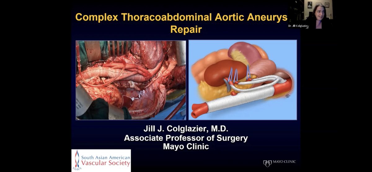 South Asian American Vascular Society (@southvascular) on Twitter photo Thank you to Dr. Jill J Colglazier for her incredibly informative talk on open thoracoabdominal surgery during our recent webinar!
Please see our link if you didn’t get to tune in live: vimeo.com/796708844
Host: <a href="/neelgalt/">Neelima Katragunta</a> Thank you to Dr. Jill J Colglazier for her incredibly informative talk on open thoracoabdominal surgery during our recent webinar!
Please see our link if you didn’t get to tune in live: vimeo.com/796708844
Host: <a href="/neelgalt/">Neelima Katragunta</a>