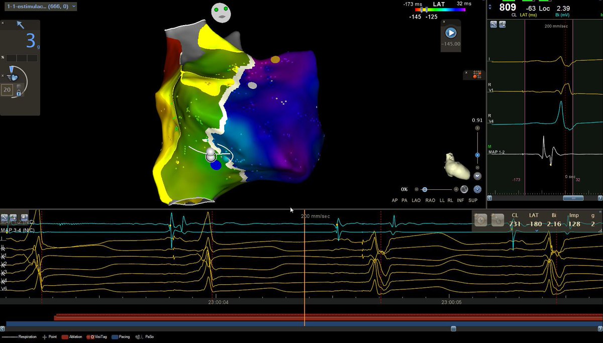 xavijoy's tweet photo. 9y 👧🏽WPW ablation of right free wall pathway in Ebstein’s anomaly. Look the difference between true and functional annulus. Open window with @BiosenseWebster #Carto @Josselyn_Piza @AlemunozAR @AndyCarto3EC @elaguiCAV @jotyin @fabianvazquezt1 @Ricardo_Reina_P @HRS_CaseReports https://t.co/4pZBPxIFEY