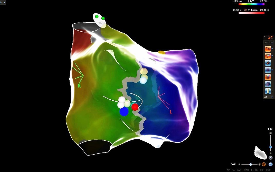 xavijoy's tweet photo. 9y 👧🏽WPW ablation of right free wall pathway in Ebstein’s anomaly. Look the difference between true and functional annulus. Open window with @BiosenseWebster #Carto @Josselyn_Piza @AlemunozAR @AndyCarto3EC @elaguiCAV @jotyin @fabianvazquezt1 @Ricardo_Reina_P @HRS_CaseReports https://t.co/4pZBPxIFEY