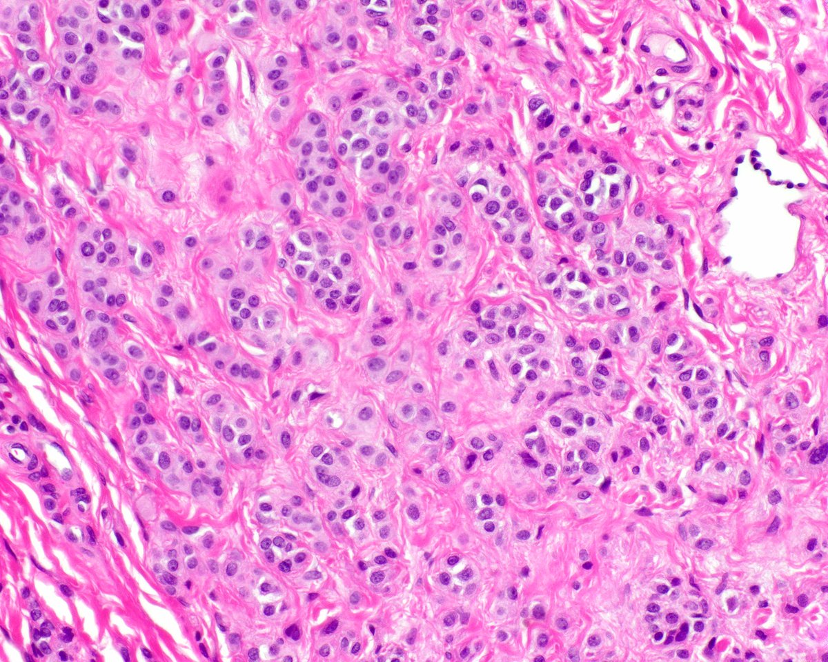 Our Miami hemorrhoids have intradermal nevi; we're that cool.