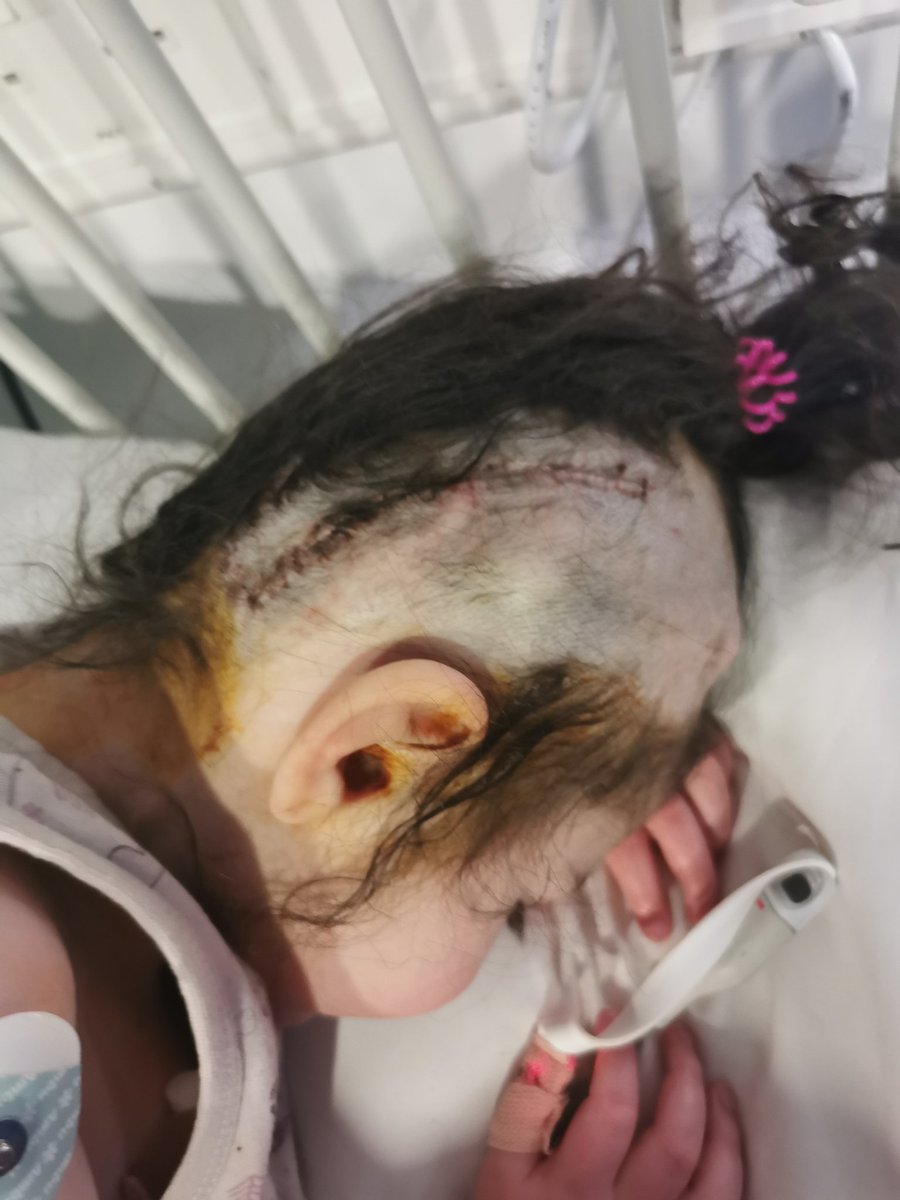 myahsjourney's tweet photo. Our beautiful brave girl - emergency brain surgery today #no6.. She does not deserve this but she gets on with it and smiles like always. In awe of you myah #hydrocephalus #shuntlife #shuntrevision https://t.co/kd0qGjmAsM