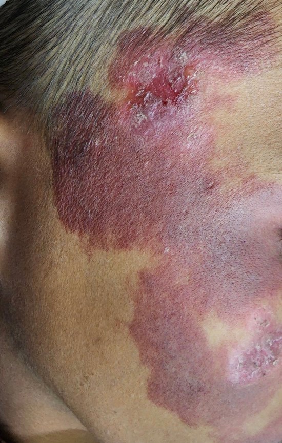 BrownJHM's tweet photo. A young boy presented with rash on one side of the face that has been present since birth. What is the likely diagnosis? #MedEd https://t.co/OcOkLpWtBR