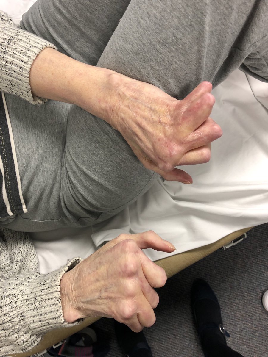 #ClinicalPearl. Describe the changes. What is the most likely #diagnosis. #MedEd #MedTwitter