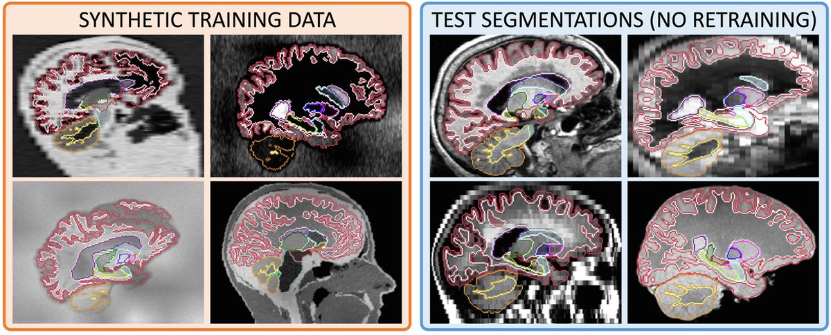 Juan Eugenio Iglesias (@juaneugenioigl1) on Twitter photo SynthSeg 1 finally accepted in Medical Image Analysis! -yes, 1 week after the paper on version 2; don't ask :-)
Paper:
sciencedirect.com/science/articl…
Code:
github.com/BBillot/SynthS…
Implementation in <a href="/FreeSurferMRI/">FreeSurfer</a> :
surfer.nmr.mgh.harvard.edu/fswiki/SynthSeg
With B.Billot @LeemputKoen <a href="/AdrianDalca/">Adrian Dalca</a> & others SynthSeg 1 finally accepted in Medical Image Analysis! -yes, 1 week after the paper on version 2; don't ask :-)
Paper:
sciencedirect.com/science/articl…
Code:
github.com/BBillot/SynthS…
Implementation in <a href="/FreeSurferMRI/">FreeSurfer</a> :
surfer.nmr.mgh.harvard.edu/fswiki/SynthSeg
With B.Billot @LeemputKoen <a href="/AdrianDalca/">Adrian Dalca</a> & others