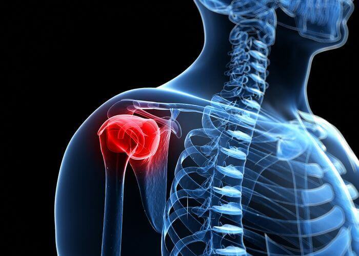 What are the symptoms of #ShoulderArthritis?

The predominant symptom is #chronicpain, which is derived from the grinding of the bones against one another after the cushioning function of the cartilage is lost. Some patients may experience some weakness...medilink.us/eqdu