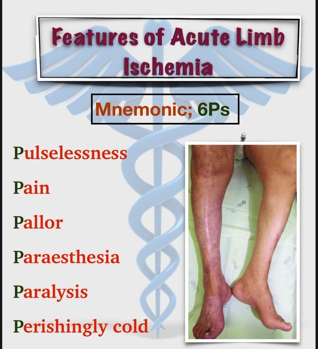 yoursmedico's tweet photo. Features of acute limb Ischemia...
#MedEdChat #MedEd #medtwitter #MedTwitterSelective
#neetpg2022counselling #NEETUG2022 #neetug2022counselling #NEETPG2023 https://t.co/2hVzITZXvY