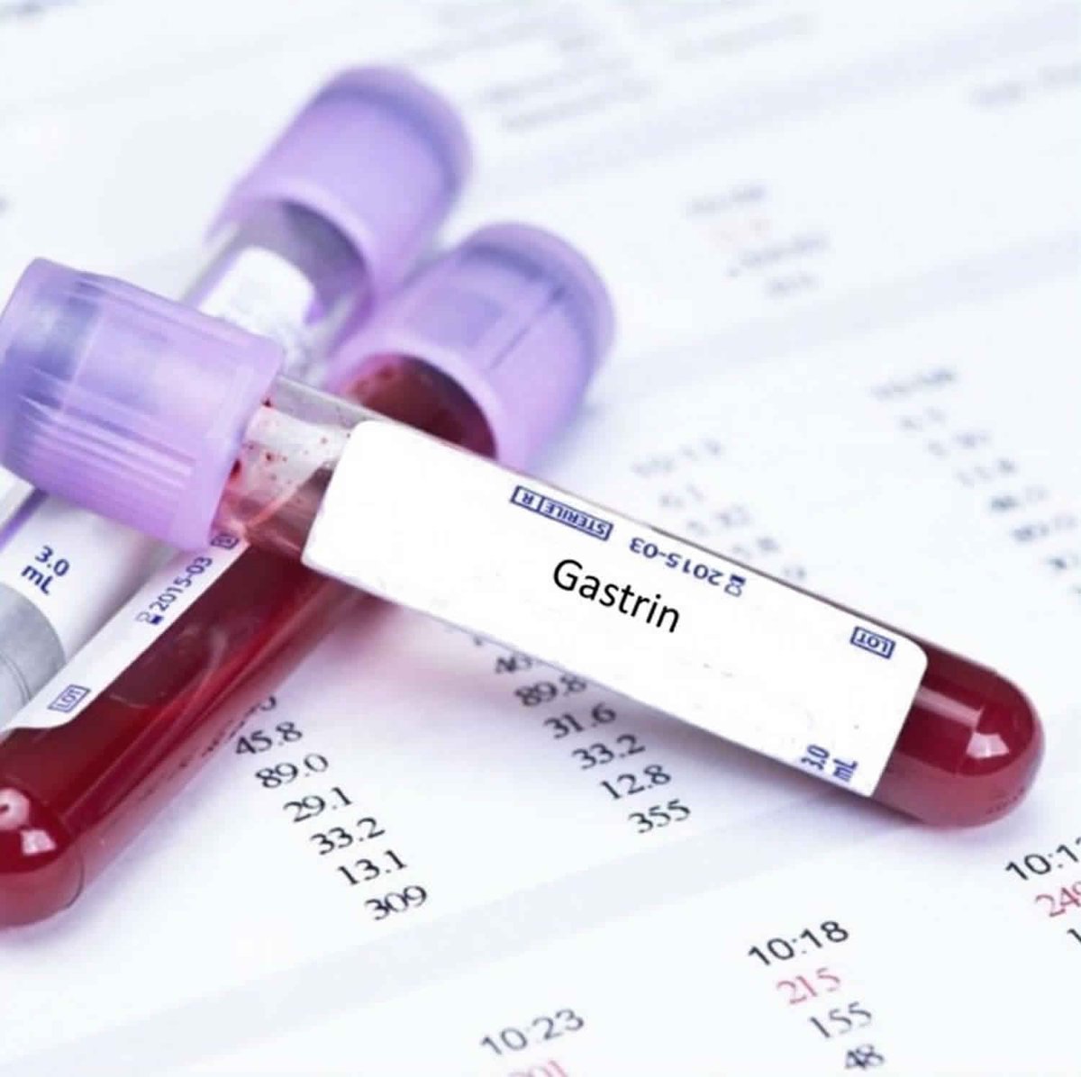 javis_joel's tweet image. Serum Gastrin

Gastrin is a peptide hormone produced by mucosal G cells of gastric antrum. Gastrin levels are pathologically increased in Gastrinoma, Gastric outlet obstruction and Hypo / Achlorhydria.

#mobilelabtesting #mobilelabservices @drtamalehenry
@MirembeDr @NallaNatural