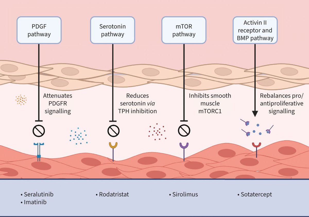 ERR: This article highlights some of the new trends in pulmonary hypertension, with a specific focus on the revised ESC/ERS 2022 guidelines for the diagnosis and management of PH. bit.ly/3Waum3Q